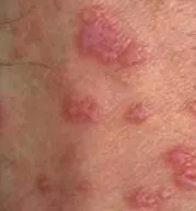 planus визначення