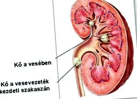 камъни бъбреците камъни бъбреците