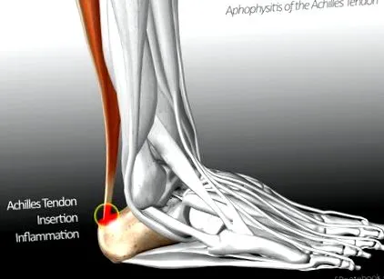 bursitis колянната