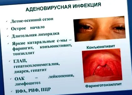 лечение хламидиални