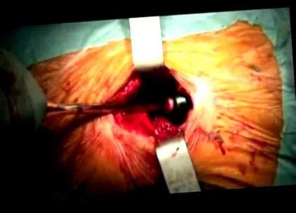 descrierea reumatism