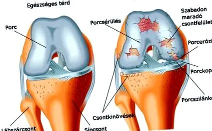 тазобедрената коксартроза