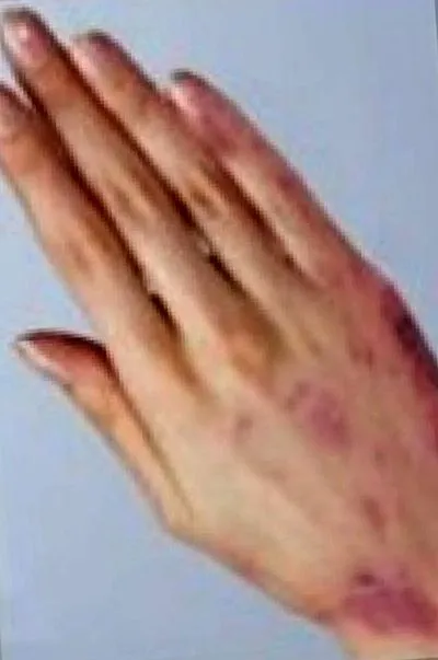 екзема екзема