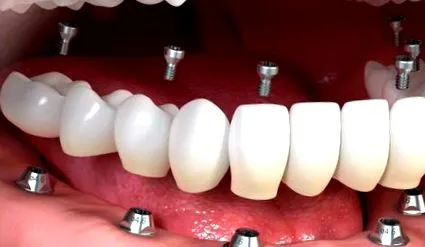 dentar implantului