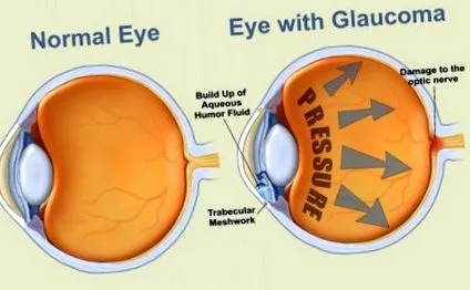 glaucomului perfectă