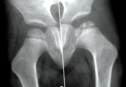 osteomielitei tenul