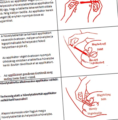папилома гърдата
