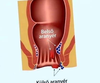 хемороиди лонго