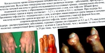 лечение заболявания