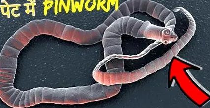 деца pinworms
