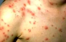 cutanată rickettsia