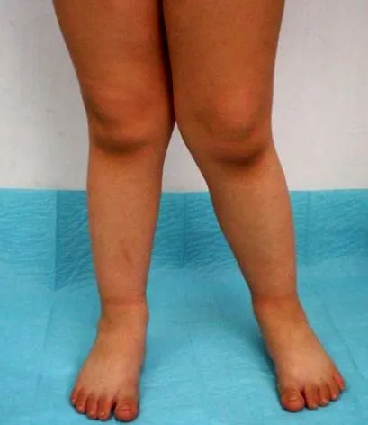 schlatter disease