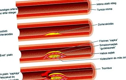 ateroscleroza