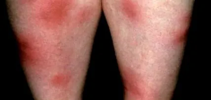 заболяване рядко