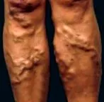 trimestru varice