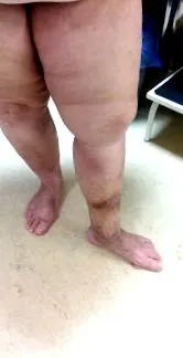 varicoase varicoase