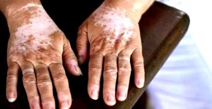 vitiligo tratamentul