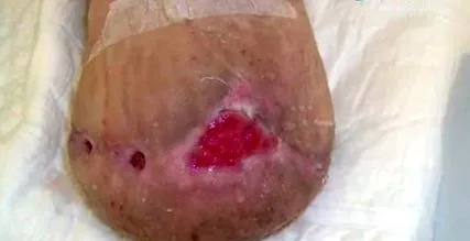 pentru varice angiologie