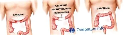 cancerul rect