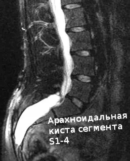 osteocondroza unguente