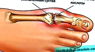 артроза метатарзофалангеалната става метатарзофалангеалната