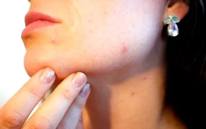 акне алое