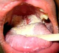 pneumoniae chlamydia