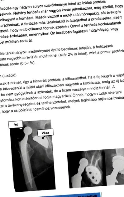 artroplastia artroplastia