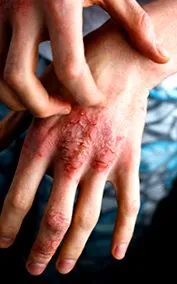 симптоми dermatica