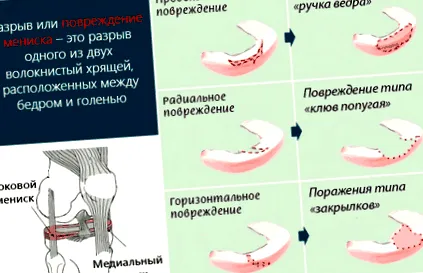 articulațiilor modificărilor