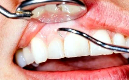 превенция венците