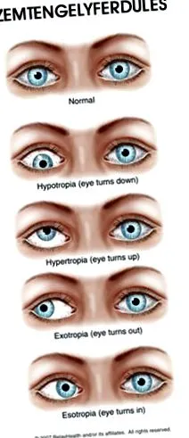 glaucomului chirurgia