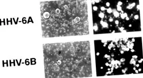 sclerozei multiple esem