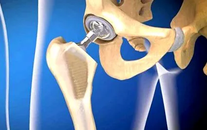 implantată șold