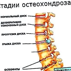 лекува гръбначния