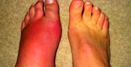 артрит подагрозен
