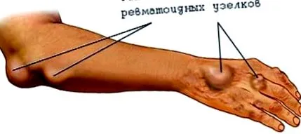гръбначния стълб гръбначния стълб