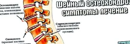 osteocondroză durere