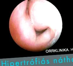 хипертрофичен ринит
