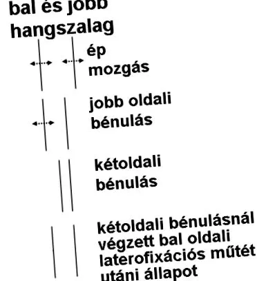залозою залозою