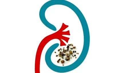 останал камъни бъбреците