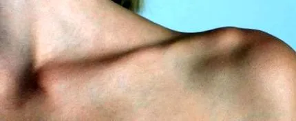 ключица ключичната