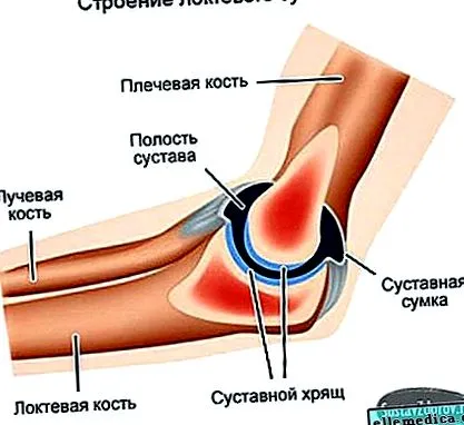 раменната бурсит