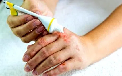 eczema renunțat