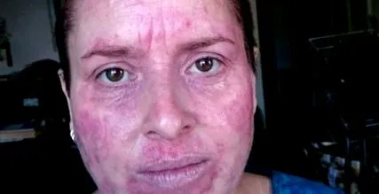 eczemă