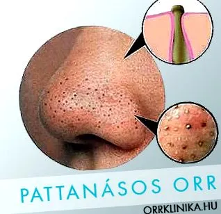 акне акне