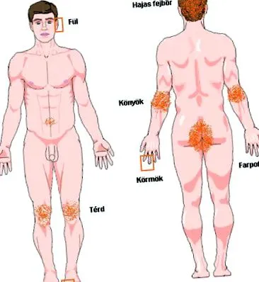 psoriazis ong-uri