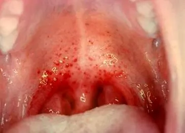 streptococcus изостря