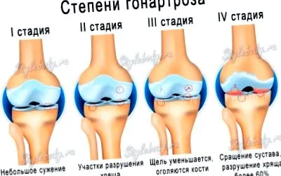 лечение гонартроза