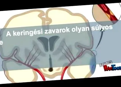 розширення варикозне
